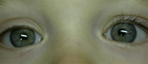 Child With Bilateral Iris Fixated Anterior Chamber Phakic Intraocular