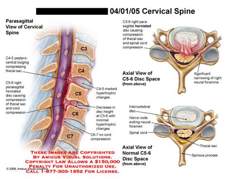 Amicus Illustration Of Amicus Injury Cervical Spine Disc Bulge C4 5 C5 6 C6 7 Cord Compression