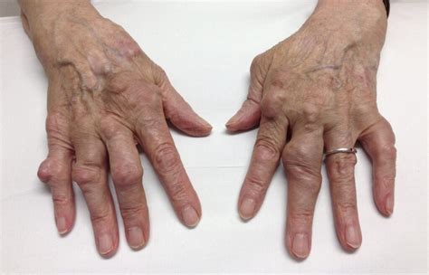Rheumatology Arthritis Tamplate