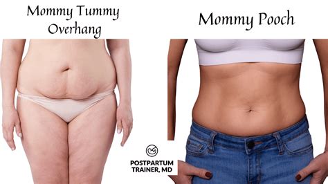 How To Lose The Mommy Tummy Overhang 5 Proven Tips Postpartum Trainer Md