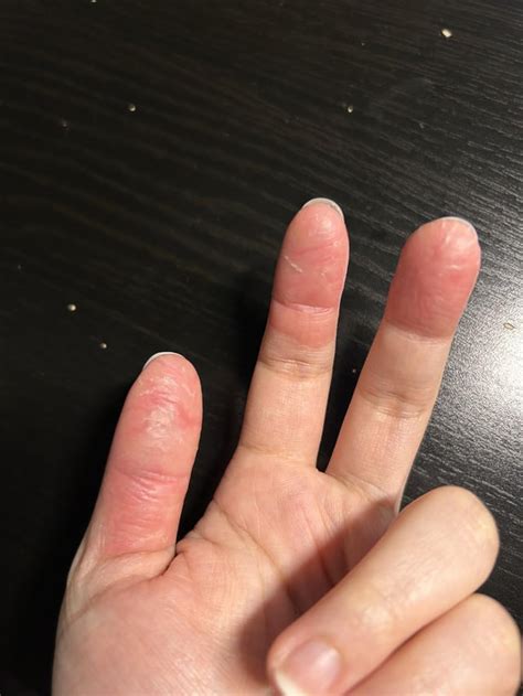 Dyshidrotic Eczema And Peeling Fingertips Reczema