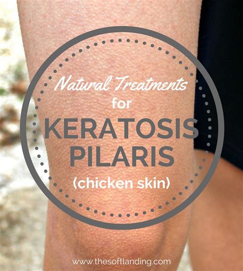 Natural Treatments For Keratosis Pilaris Chicken Skin