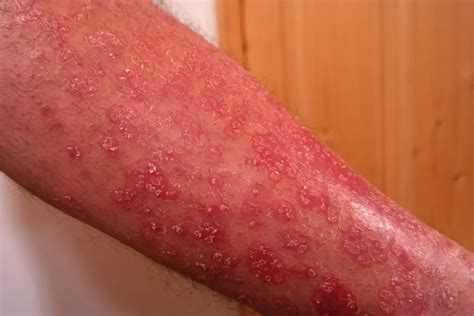 Best Over The Counter Psoriasis Cream 2018 Psoriasis Treatment That