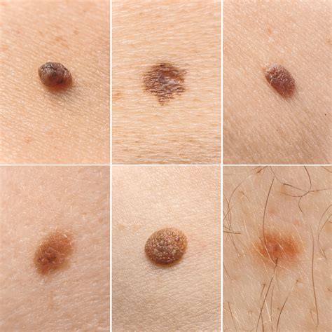 Understanding The Different Types Of Moles Spot Check Clinic 2022