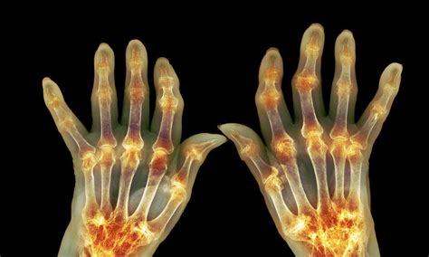 radang sendi arthritis gejala penyebab hingga pengobatan