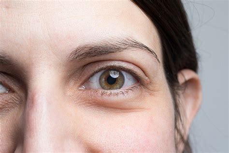 Eye Bags Understanding And Treating Them Cambridge Medical Group