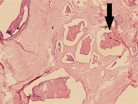 Histopathological Slide Showing Calcium Deposits Indicated By Black
