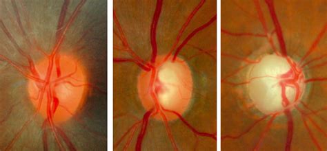 Normal Optic Disc And Glaucomatous Optic Nerve Heads New Glaucoma