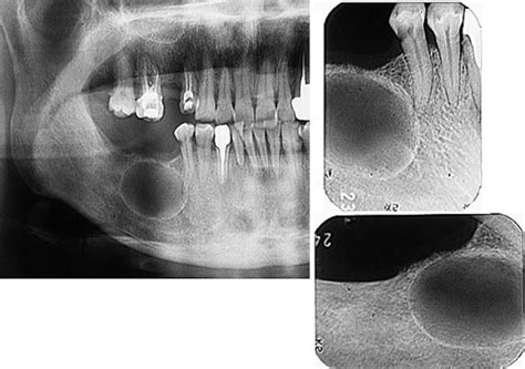 Cysts Of The Jaw Part 1 Intelligent Dental