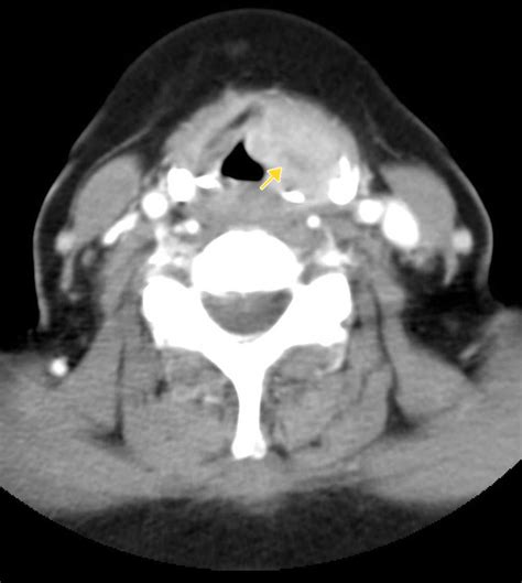 Laryngeal Cancer Staging