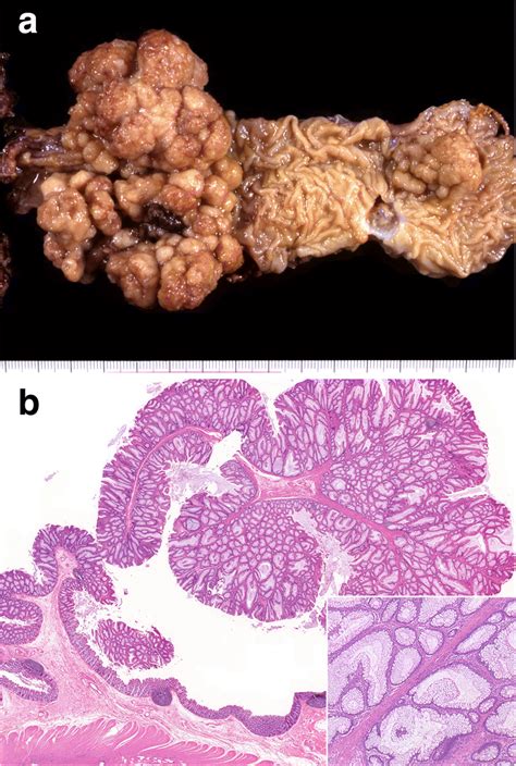 Rectal Cancer Developing From An Anastomotic Site 18 Years After