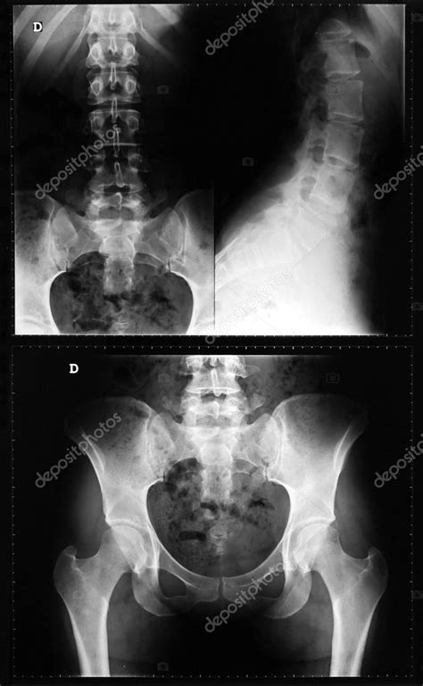 Radiografía De La Columna Vertebral Y La Pelvis De Una Mujer