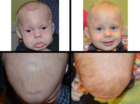 Endoscopic Craniosynostosis Repair Before And After Photo Gallery St