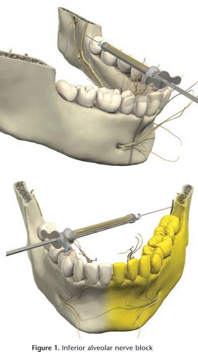 Lingual Nerve Block Dental Assistant Study Dental Hygiene School