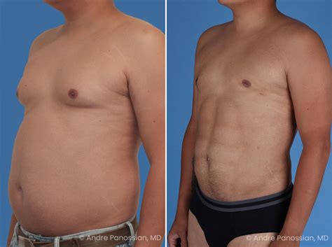 Abdominal High Definition Liposuction Photos Pasadena Ca Patient
