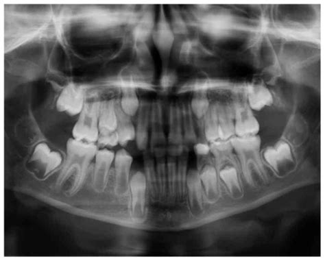 Management Of Large Inflammatory Dentigerous Cysts Adapted To The