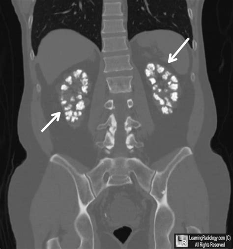 Learningradiology Medullary Nephrocalcinosis Calcification Renal