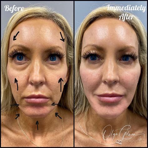 10 Thread Lift Before And After Pictures Thread Lift Thread Lift Face