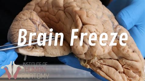 What Is A Brain Freeze Youtube