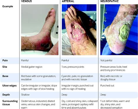 Diagnosis And Management Of Venous Leg Ulcers The Bmj
