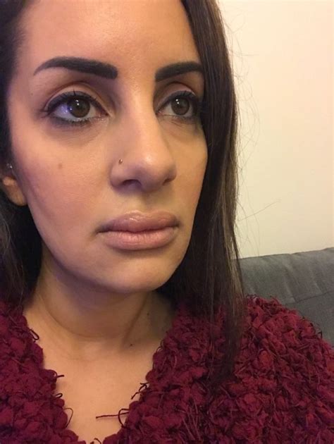 Botched Lip Fillers Left Woman With Rock Hard Blue Lumps On Her Mouth Metro News