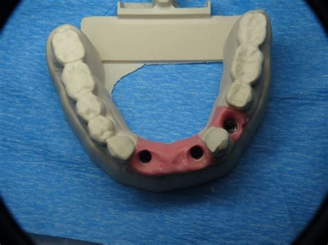 Immediate Implant Bridge Lower Jaw Front Teeth Ramsey Amin Dds