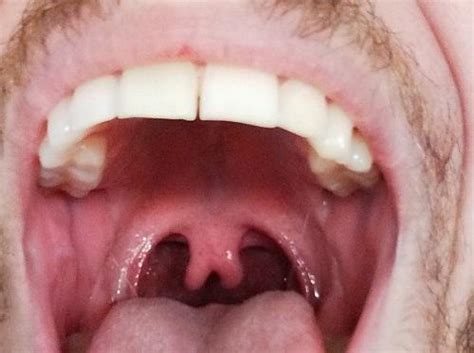 Reddit User Shares Bifid Uvula Rare Condition That Only Occurs In 2