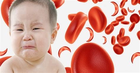 Anemia Falciforme Doença Causada Por Mutação Genética Saúde And Conhecimento