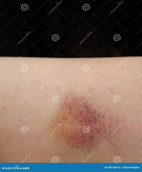 Bruised Arm Isolated On Black Stock Image Image Of Skin Isolated