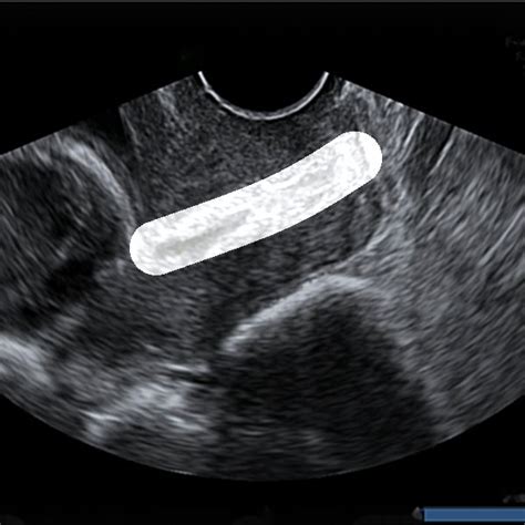 Results Of Cervical Segmentation On Transvaginal Ultrasound Images