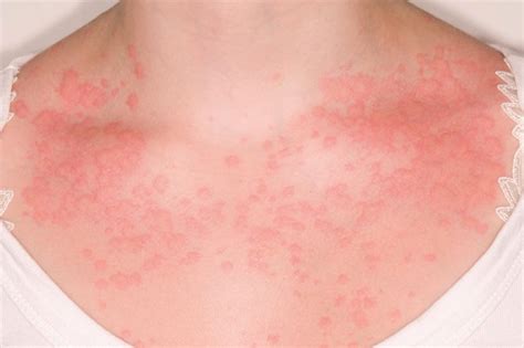Chronic Spontaneous Urticaria Clinical Features Diagnosis And