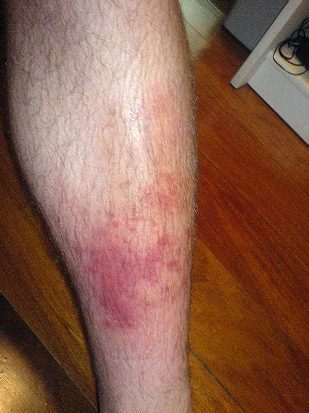 What Is Cellulitis Cellulitis Infection Cellulitis Pictures