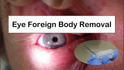 Eye Foreign Body Removal Youtube