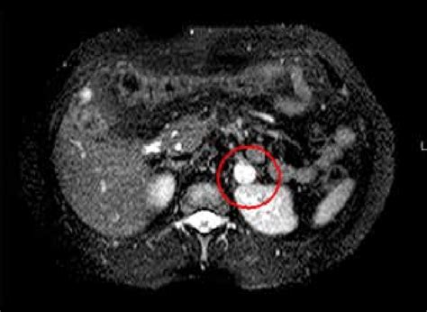 Abdominal Contrast Enhanced Ct Scan A Solid 18 Mm Left Adrenal Mass