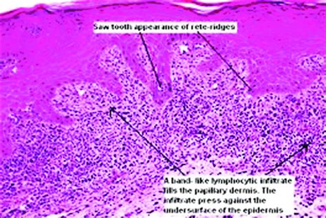 Histology Of Oral Lichen Planus Download Scientific Diagram