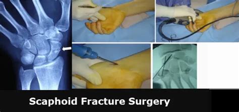 Scaphoid Bone Fracture Surgery