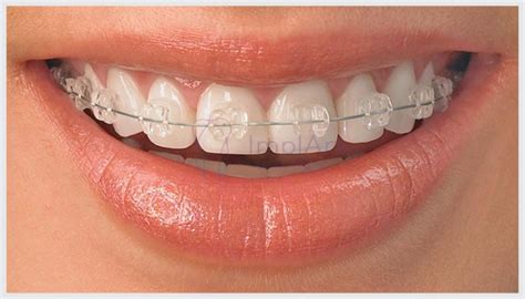 dor na atm pode ser tratada  aparelho ortodontico