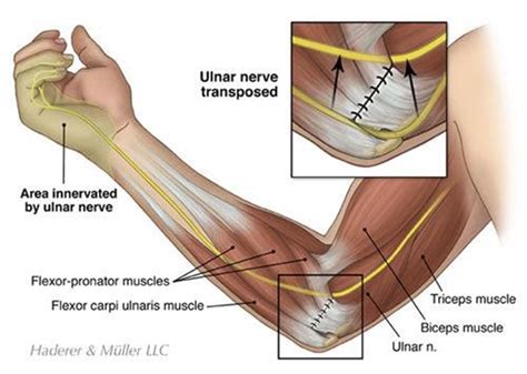 Professional Ulnar Nerve Transposition Surgery Sforzo Dillingham