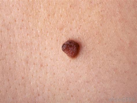 How Do I Identify A Cancerous Mole With Pictures