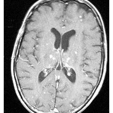MRI Brain With And Without Contrast T Axial Postcontrast Image Download Scientific Diagram