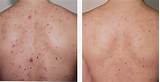 Pictures of Best Treatment For Bacne Scars
