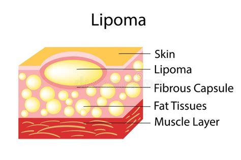 Lipoma Are Adipose Tumors Located In The Subcutaneous Tissues Stock