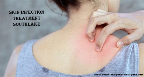 Soft Skin Tissue Infection Diagnosis And Treatment Southlake General
