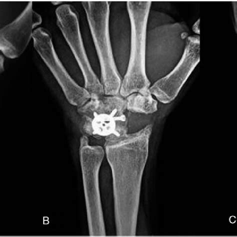 Wrist With A SNAC III Lesion A Final Radiograph Of Four Corner Download Scientific Diagram