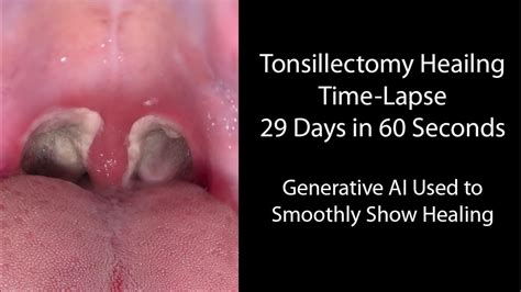 Healing Time Lapse After Tonsillectomy Days In Seconds Youtube
