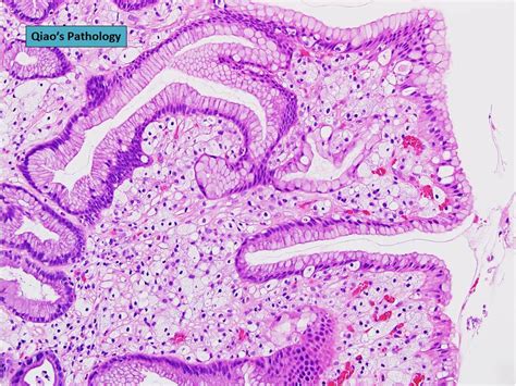 Qiaos Pathology Gastric Xanthoma In Hyperplastic Polyp A Photo On