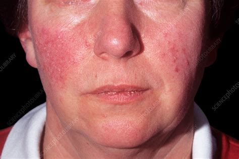 Acne Rosacea Stock Image C0372746 Science Photo Library