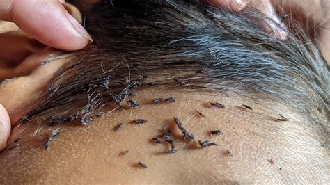 Getting Out All Hundred Lice From His Head Remove Thousand Lice From