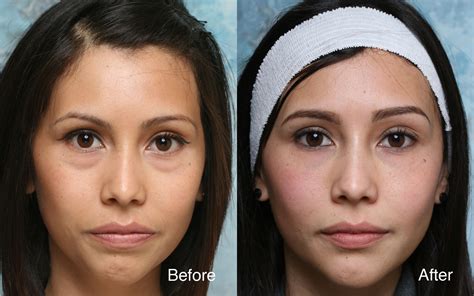 Under Eye Filler Before And After Photos All You Need Infos