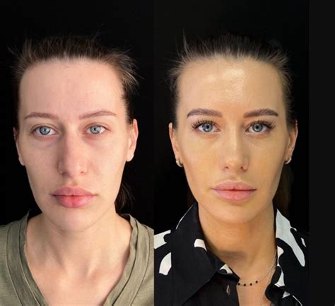 Incredible Transformations Of Women Before And After Nose Job 10 Photos Interesting